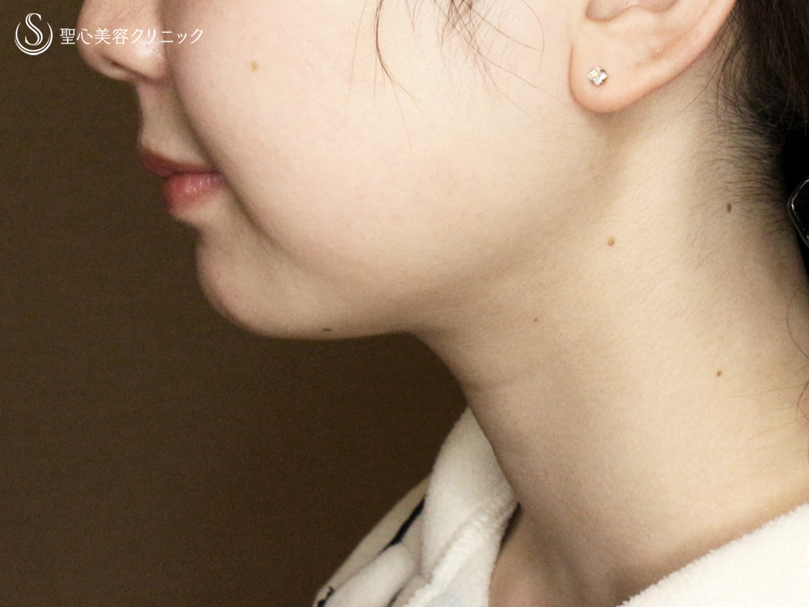 【20代女性・抜群の小顔効果】「あご下」脂肪吸引注射（直後〜1ヶ月後） After 