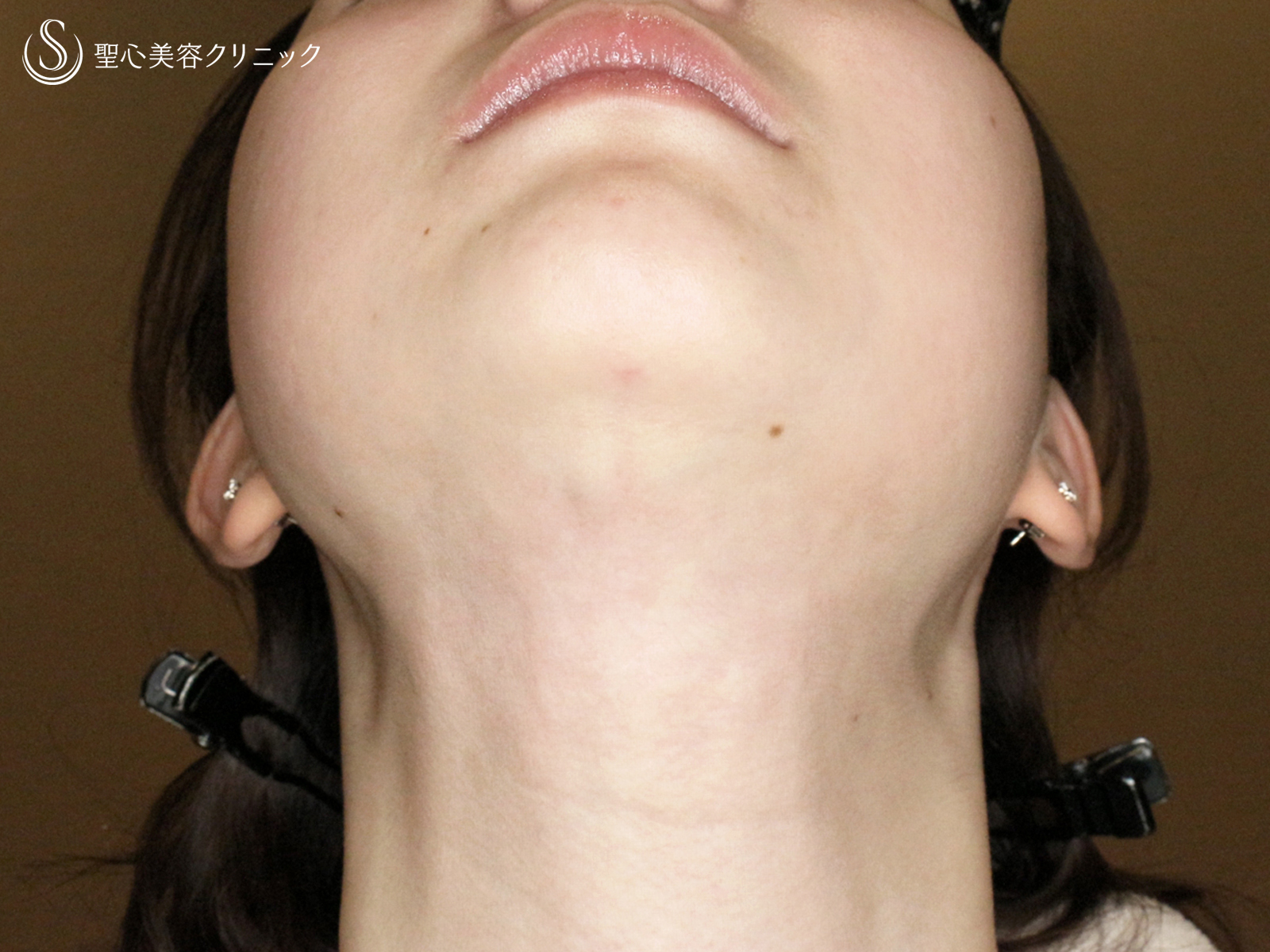 【20代女性・抜群の小顔効果】「あご下」脂肪吸引注射（直後〜1ヶ月後） After 