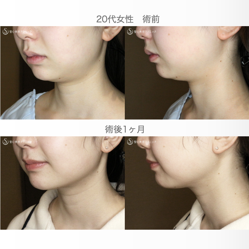 【20代女性・抜群の小顔効果】「あご下」脂肪吸引注射（直後〜1ヶ月後） After 