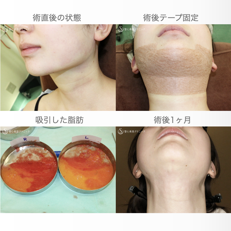 【20代女性・抜群の小顔効果】「あご下」脂肪吸引注射（直後〜1ヶ月後） Before 