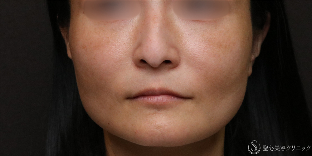 【40代女性・気になる法令線と頬の凹みに】プレミアムPRP皮膚再生療法（半年後） After 