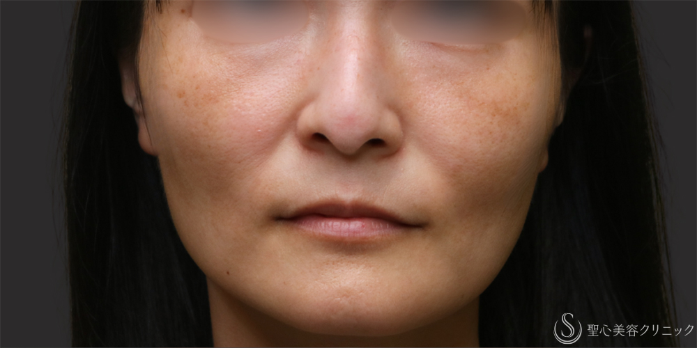 【40代女性・気になる法令線と頬の凹みに】プレミアムPRP皮膚再生療法（半年後） Before 