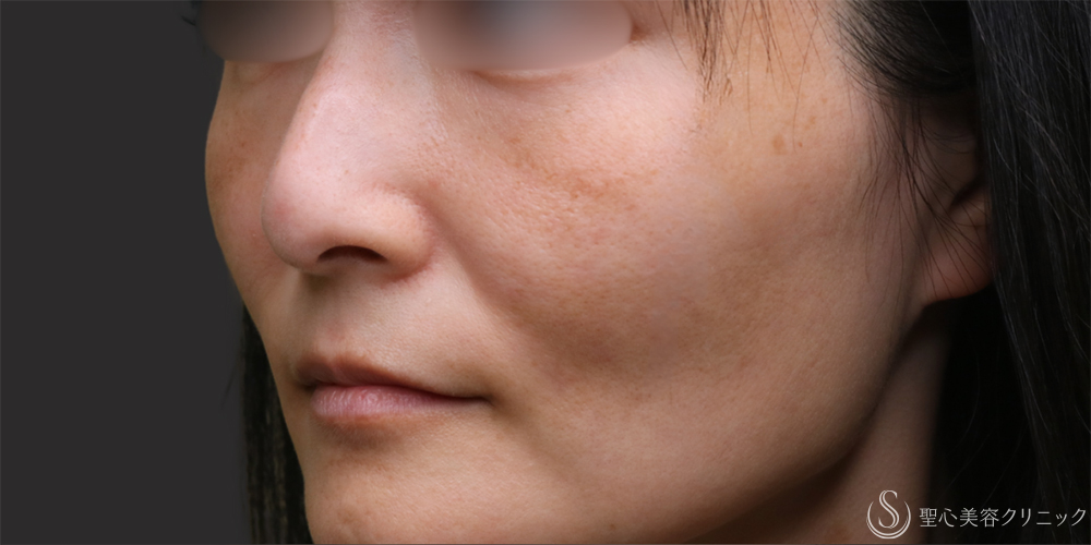 【40代女性・気になる法令線と頬の凹みに】プレミアムPRP皮膚再生療法（半年後） Before 