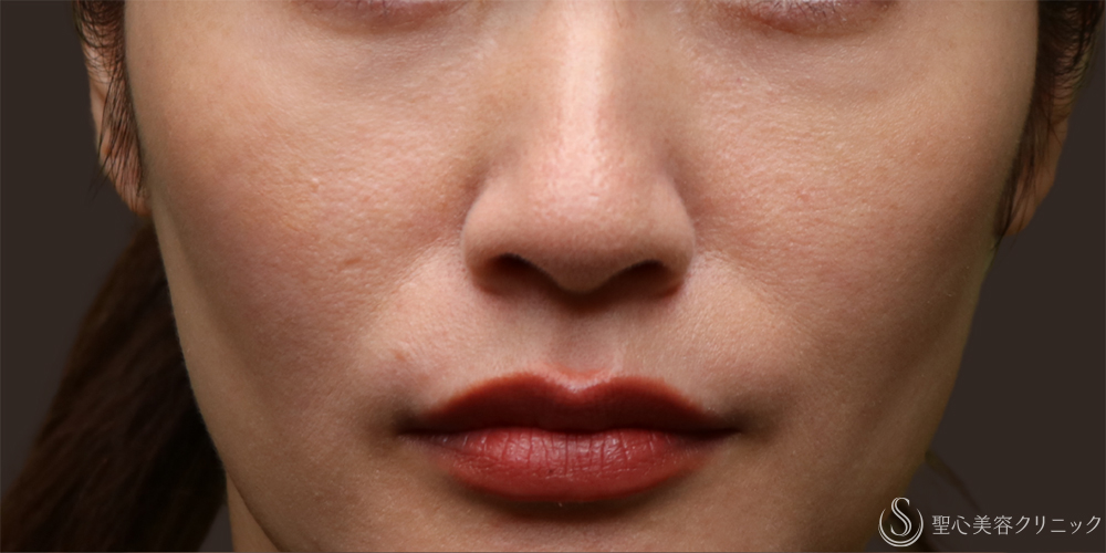 【40代女性・自然な若返り】プレミアムPRP皮膚再生療法（目の下・法令線）（9ヶ月後） Before 