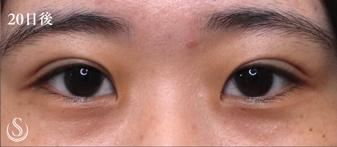 【20代女性・目元を華やかに】二重術（埋没法）：マイクロメソッド+α（2ヶ月後） After 