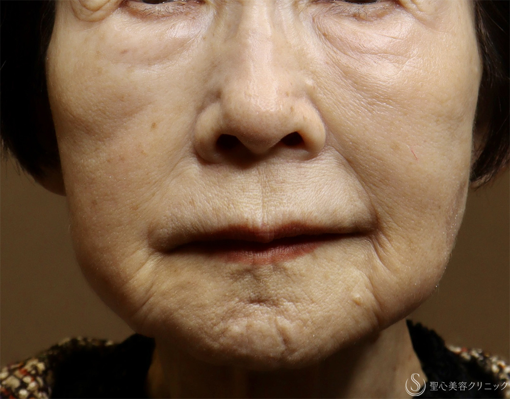 【80代女性・肌育で若返り】プレミアムPRP皮膚再生療法（3年後） After 