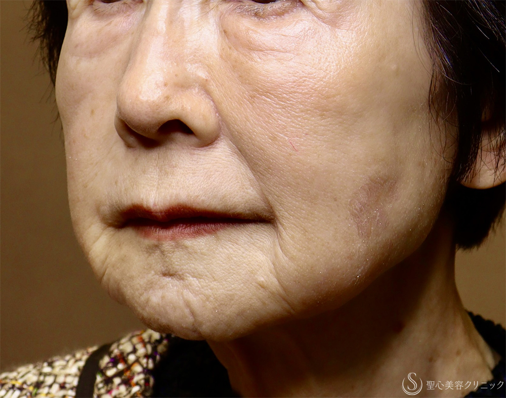 【80代女性・肌育で若返り】プレミアムPRP皮膚再生療法（3年後） After 