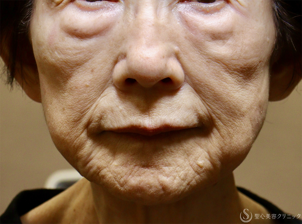 【80代女性・肌育で若返り】プレミアムPRP皮膚再生療法（3年後） Before 