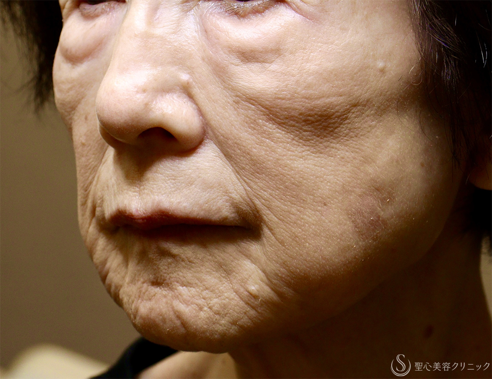 【80代女性・肌育で若返り】プレミアムPRP皮膚再生療法（3年後） Before 