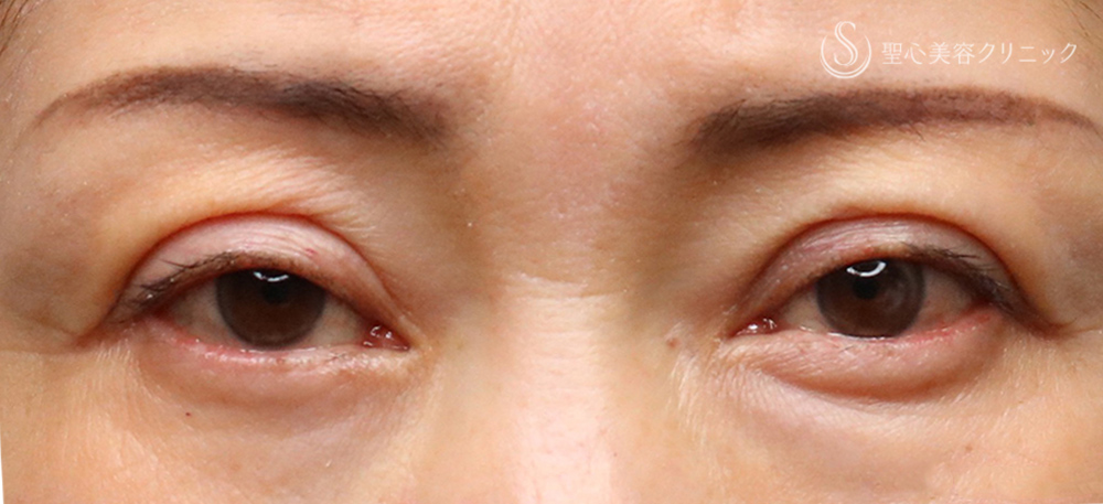 【50代女性・目の上の窪みを整えて、やさしい印象へ】プレミアムPRP皮膚再生療法（目の上）（2年後） After 名古屋+目の上の窪み　アンチエイジング