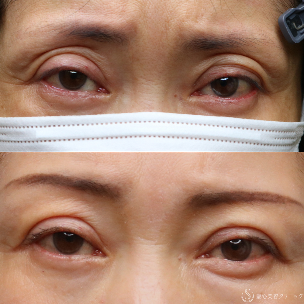【50代女性・目の上の窪みを整えて、やさしい印象へ】プレミアムPRP皮膚再生療法（目の上）（2年後） After 名古屋+目の上の窪み　アンチエイジング