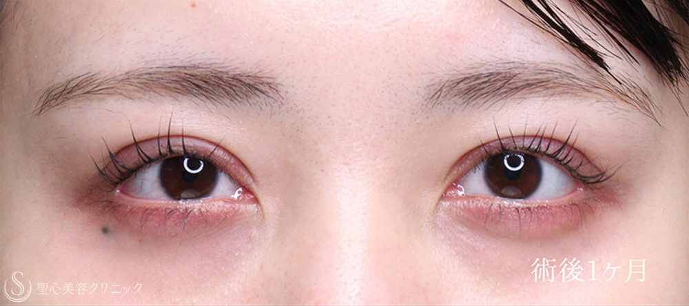 【20代女性・目力をアップ】眼瞼下垂（切開法/腱膜縫縮法）（1週間後～4ヶ月後） After 