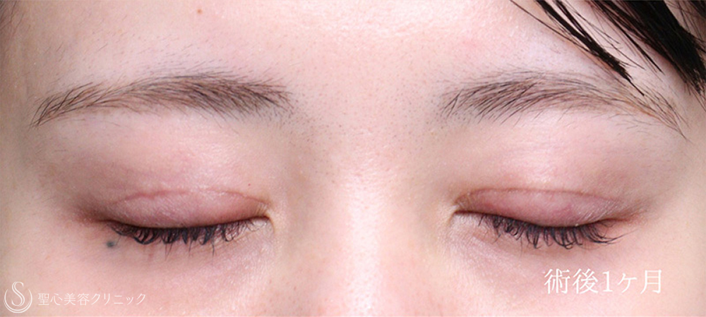 【20代女性・目力をアップ】眼瞼下垂（切開法/腱膜縫縮法）（1週間後～4ヶ月後） After 