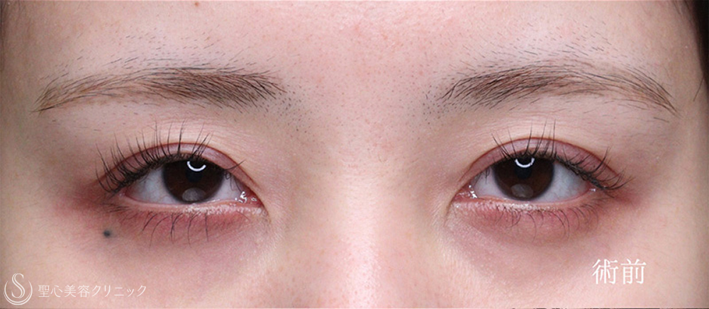 【20代女性・目力をアップ】眼瞼下垂（切開法/腱膜縫縮法）（1週間後～4ヶ月後） Before 