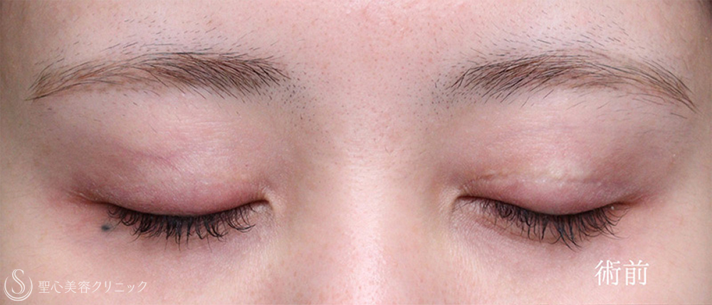 【20代女性・目力をアップ】眼瞼下垂（切開法/腱膜縫縮法）（1週間後～4ヶ月後） Before 