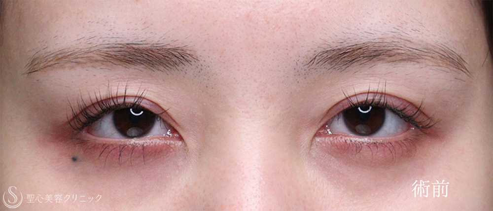 【20代女性・目力をアップ】眼瞼下垂（切開法/腱膜縫縮法）（1週間後～4ヶ月後） Before 