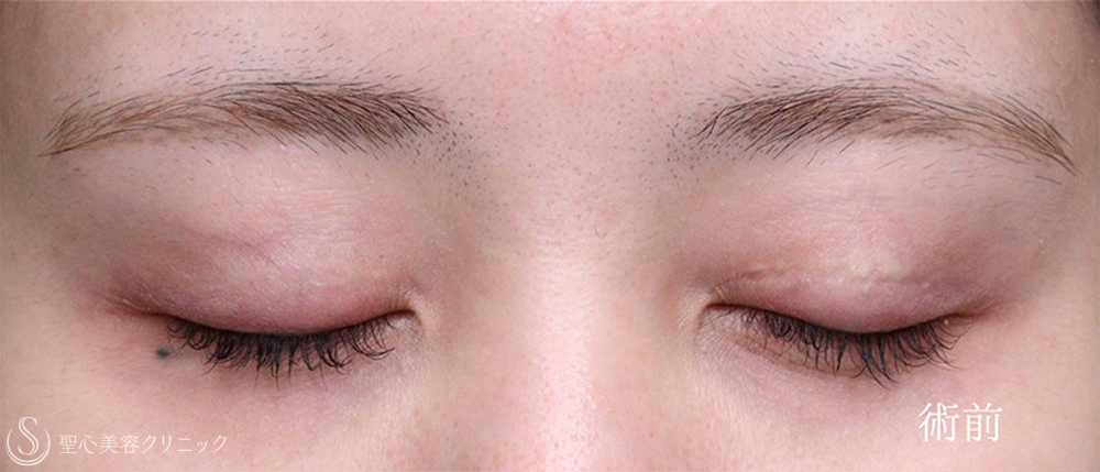 【20代女性・目力をアップ】眼瞼下垂（切開法/腱膜縫縮法）（1週間後～4ヶ月後） Before 