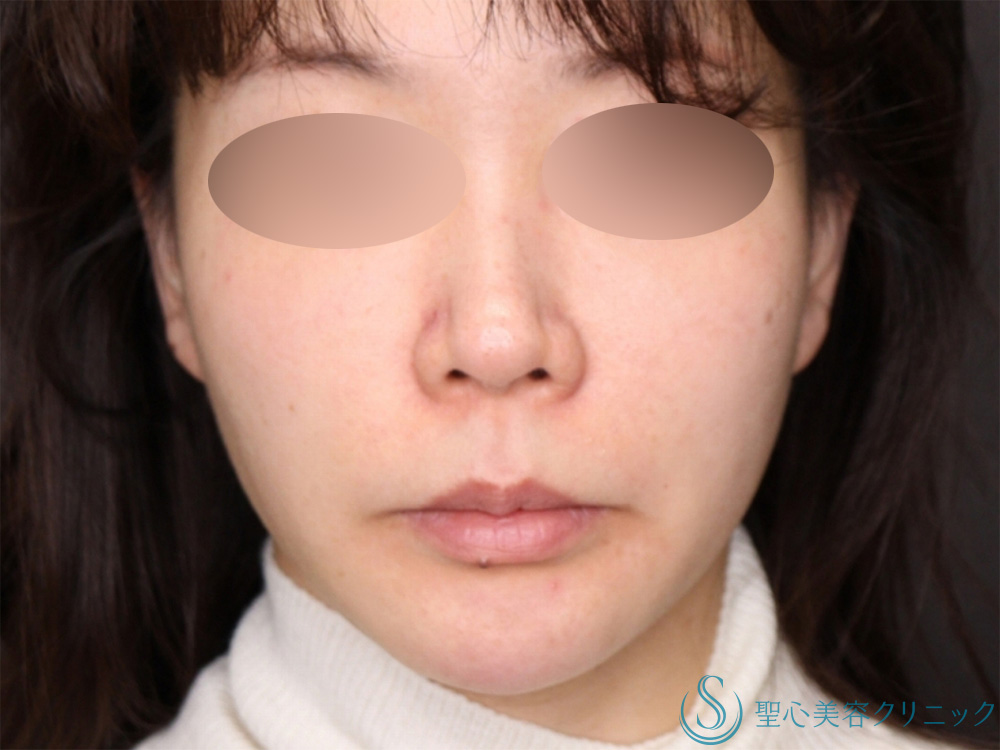 【40代女性・糸リフトのコンビネーションでたるみも肌のハリも改善！！】PDRNコーティングスレッド（10本）＋PDRNモノスレッド（40本）（3か月後） After 