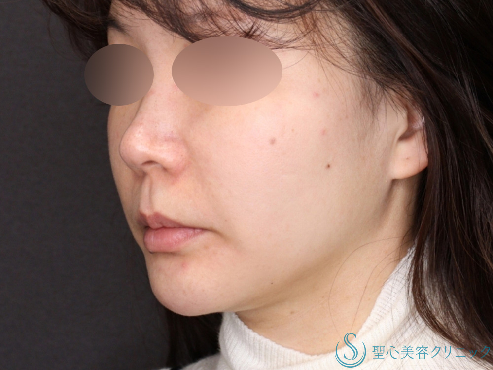 【40代女性・糸リフトのコンビネーションでたるみも肌のハリも改善！！】PDRNコーティングスレッド（10本）＋PDRNモノスレッド（40本）（3か月後） After 