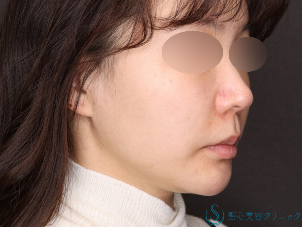 【40代女性・糸リフトのコンビネーションでたるみも肌のハリも改善！！】PDRNコーティングスレッド（10本）＋PDRNモノスレッド（40本）（3か月後） After 