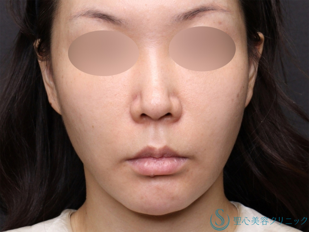 【40代女性・糸リフトのコンビネーションでたるみも肌のハリも改善！！】PDRNコーティングスレッド（10本）＋PDRNモノスレッド（40本）（3か月後） Before 