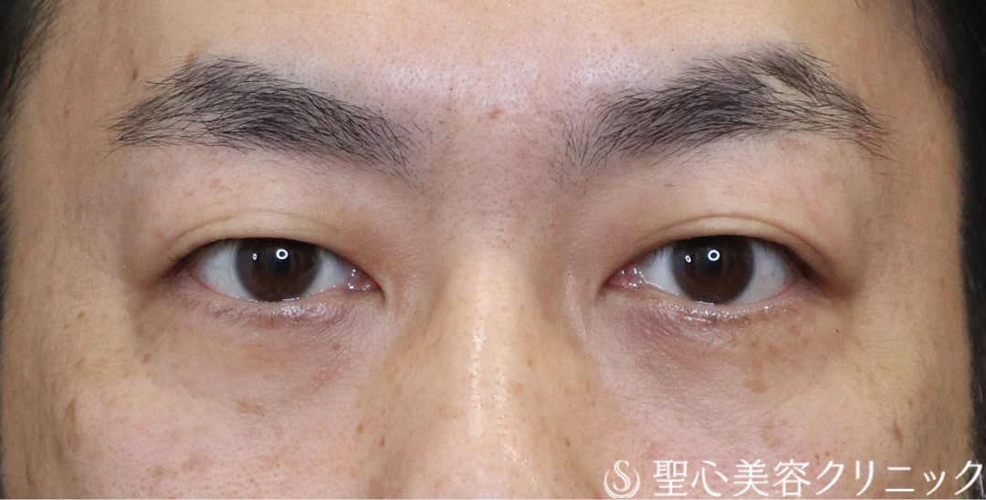 【40代男性・目の下のクマ】経結膜下脱脂法（1ヶ月後～3ヶ月後） After 