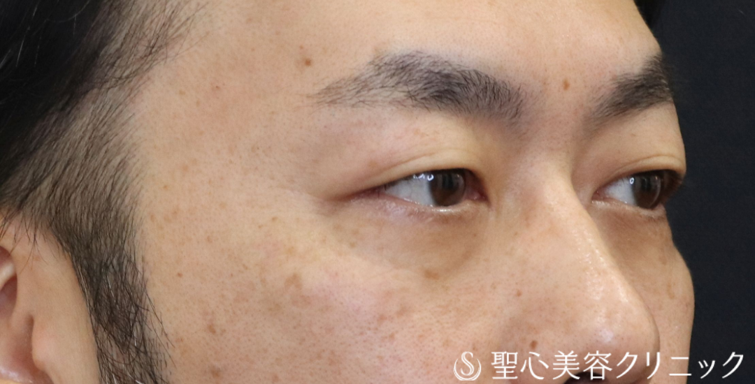 【40代男性・目の下のクマ】経結膜下脱脂法（1ヶ月後～3ヶ月後） After 