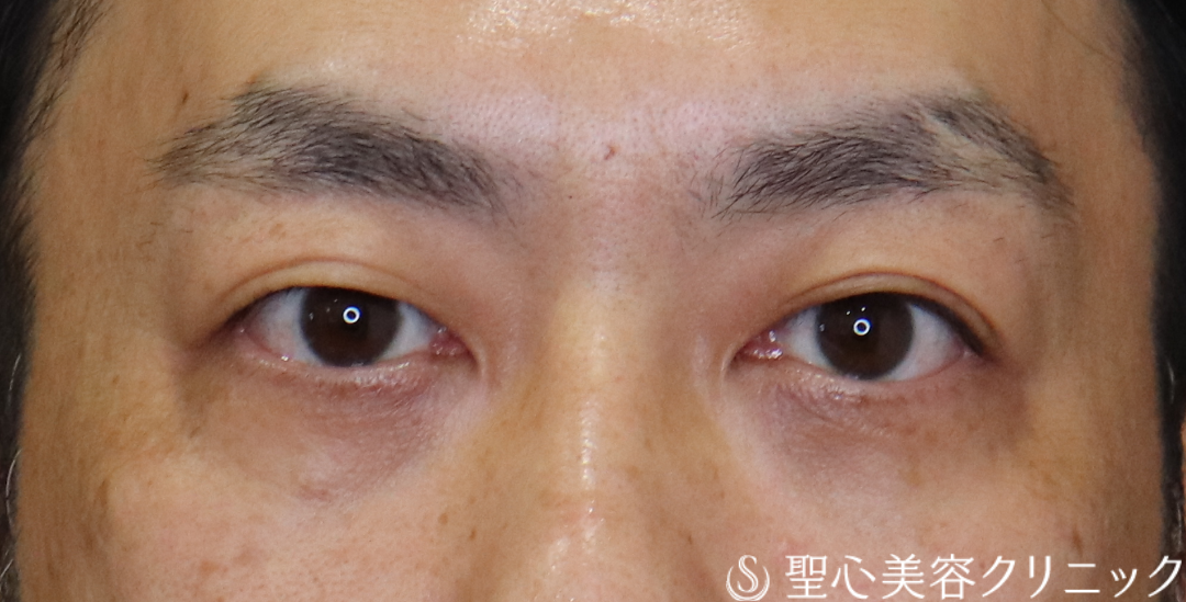 【40代男性・目の下のクマ】経結膜下脱脂法（1ヶ月後～3ヶ月後） After 