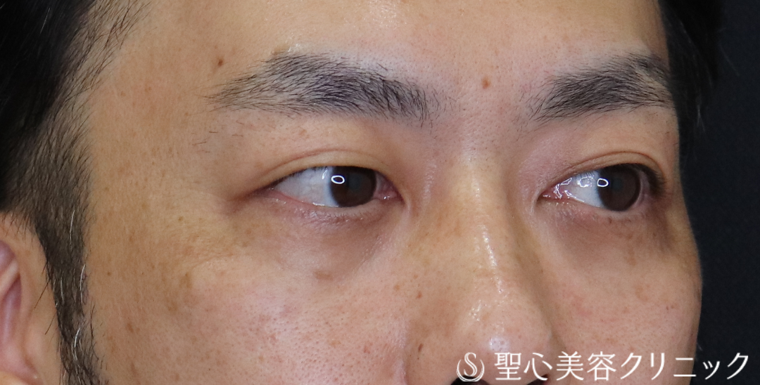 【40代男性・目の下のクマ】経結膜下脱脂法（1ヶ月後～3ヶ月後） After 