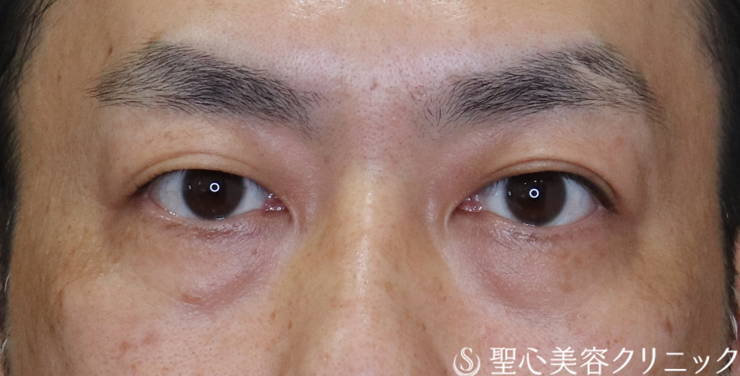 【40代男性・目の下のクマ】経結膜下脱脂法（1ヶ月後～3ヶ月後） Before 