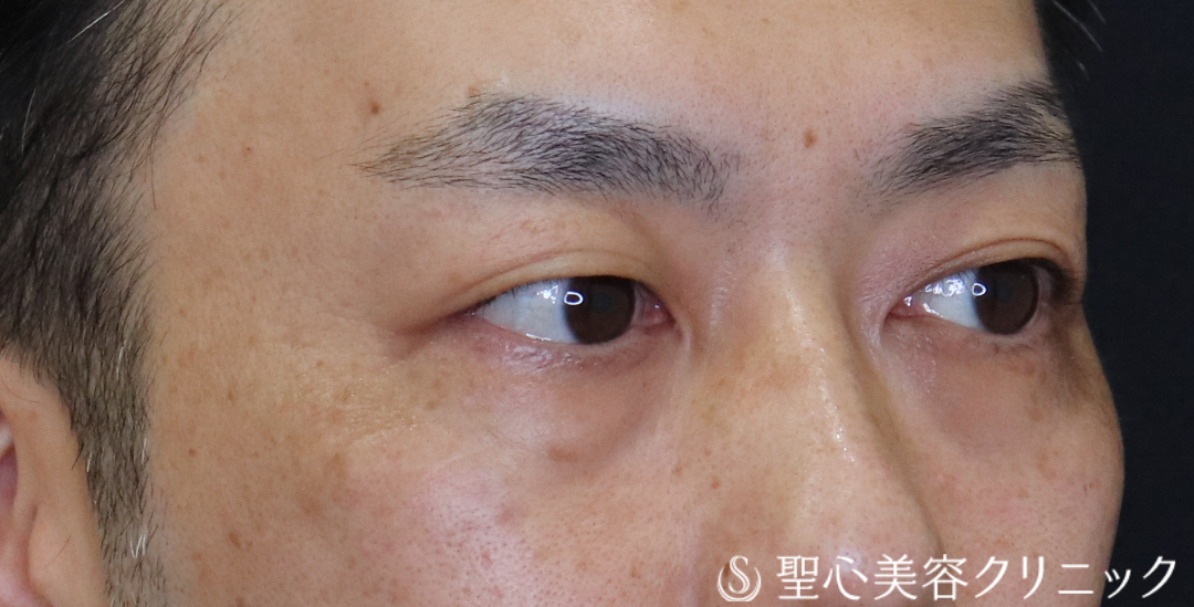 【40代男性・目の下のクマ】経結膜下脱脂法（1ヶ月後～3ヶ月後） Before 