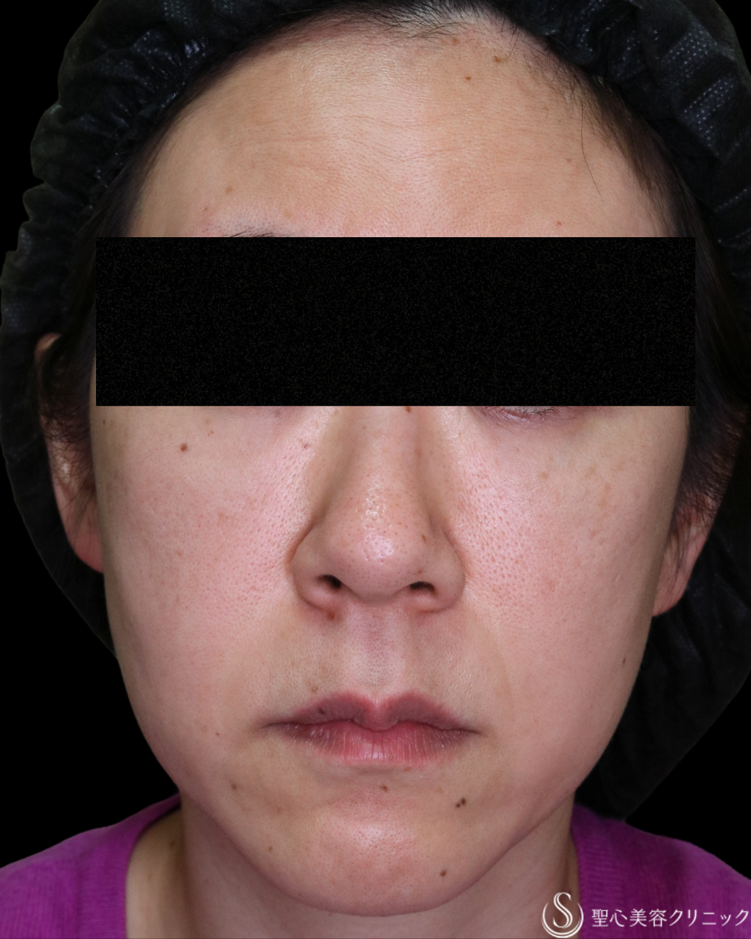 【50代女性・どんどん若く】プレミアムPRP皮膚再生療法＋ しみ・アザ取りレーザー＋CellecV（セレックV）_シミ（5年後） After 