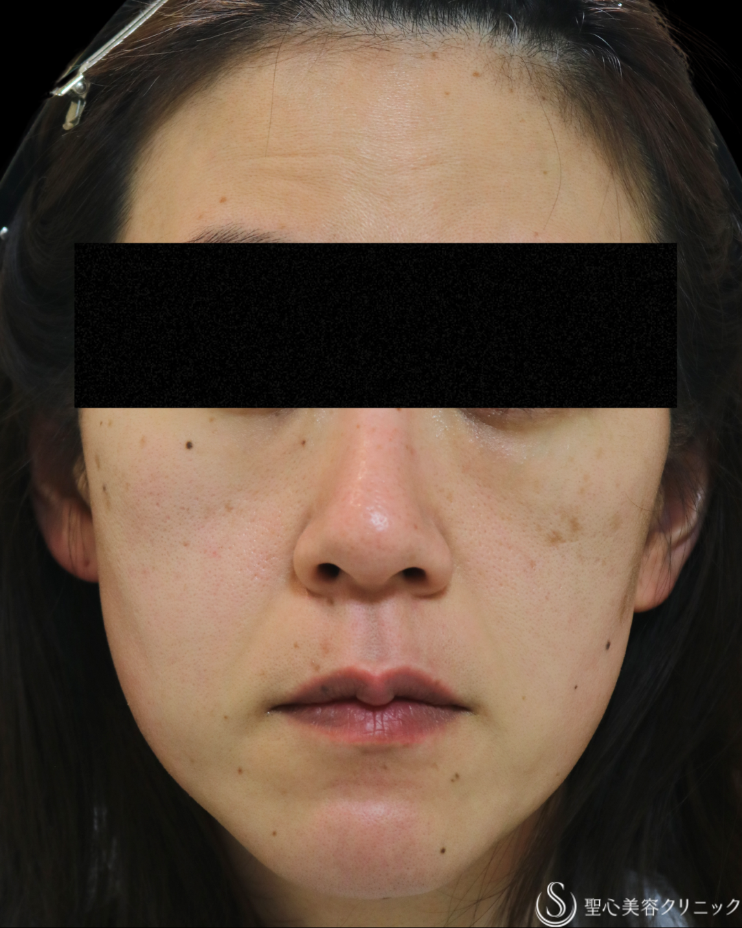 【50代女性・どんどん若く】プレミアムPRP皮膚再生療法＋ しみ・アザ取りレーザー＋CellecV（セレックV）_シミ（5年後） Before 
