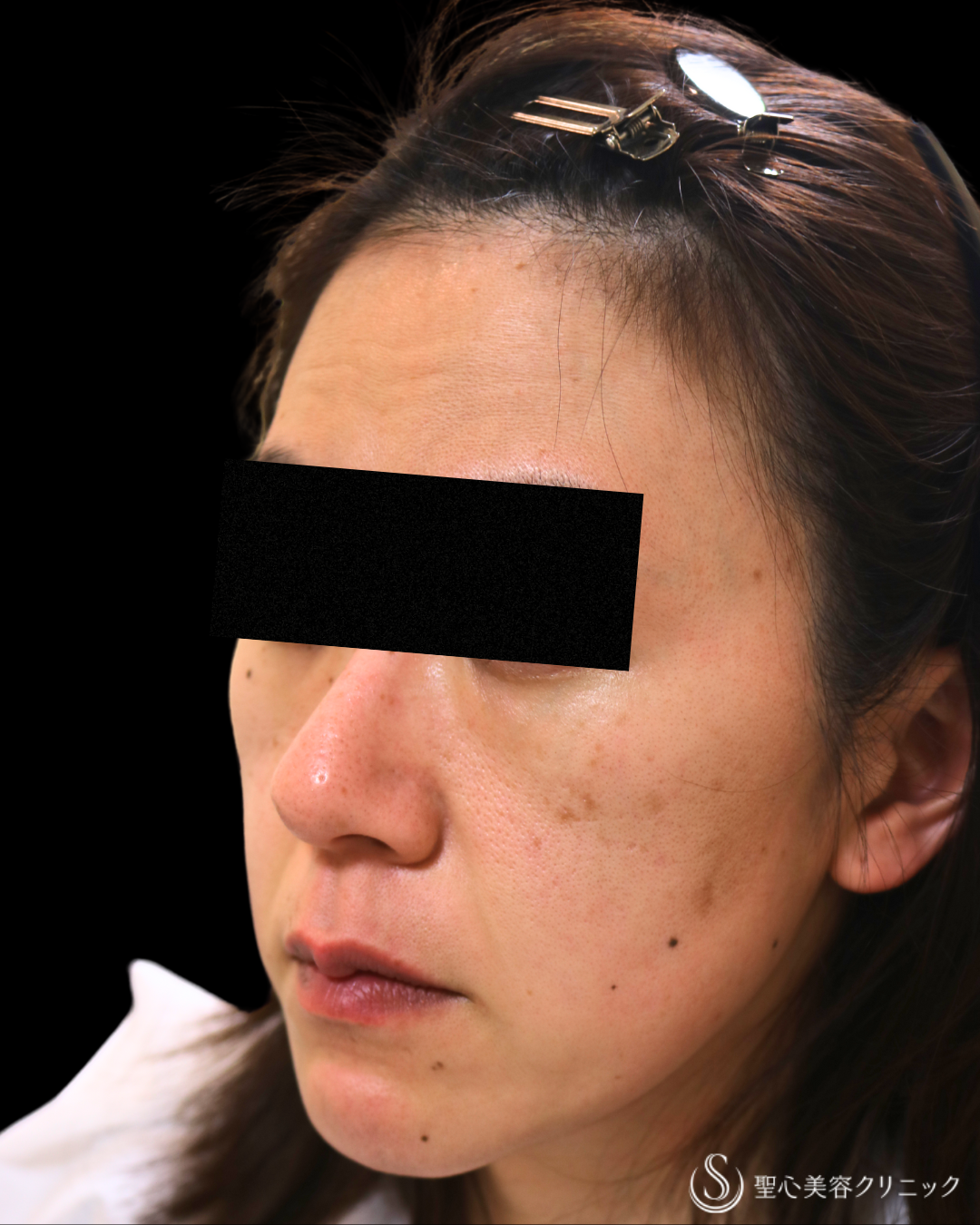【50代女性・どんどん若く】プレミアムPRP皮膚再生療法＋ しみ・アザ取りレーザー＋CellecV（セレックV）_シミ（5年後） Before 