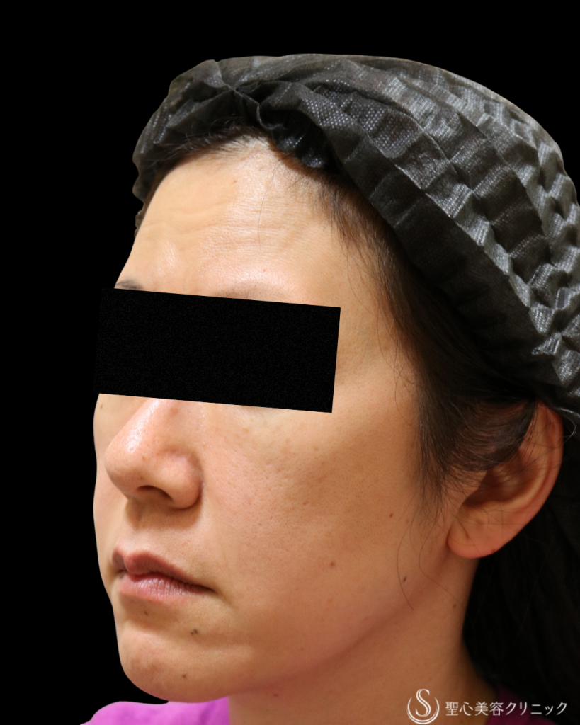 【50代女性・どんどん若く】プレミアムPRP皮膚再生療法＋ しみ・アザ取りレーザー＋CellecV（セレックV）_シミ（5年後） After 