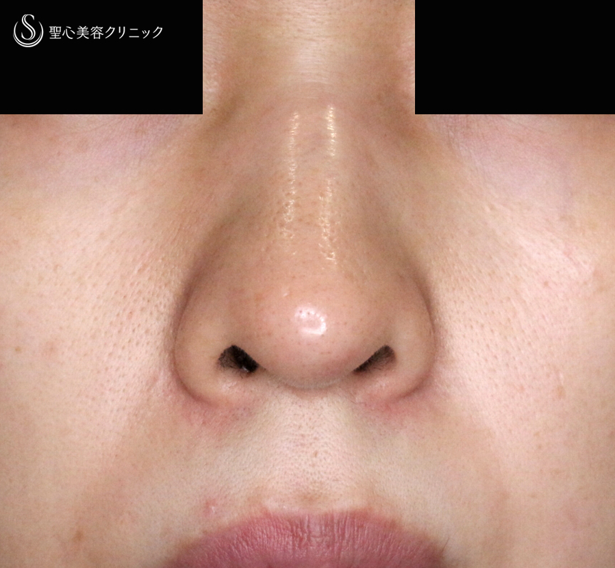 【30代女性・三角形の鼻の穴を整える】鼻孔縁下降術（術直後〜1年後） Before 