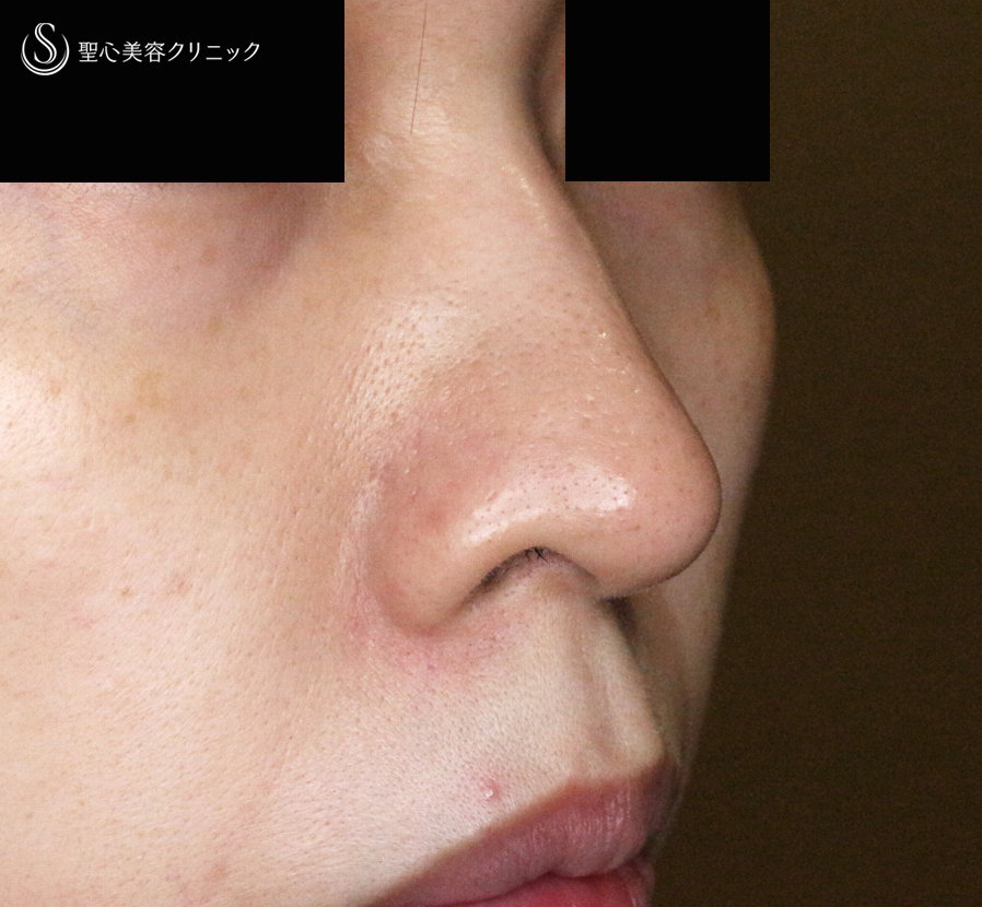 【30代女性・三角形の鼻の穴を整える】鼻孔縁下降術（術直後〜1年後） Before 