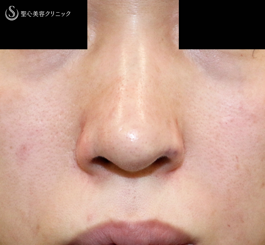 【30代女性・三角形の鼻の穴を整える】鼻孔縁下降術（術直後〜1年後） Before 