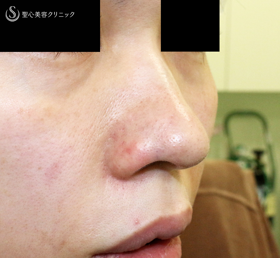 【30代女性・三角形の鼻の穴を整える】鼻孔縁下降術（術直後〜1年後） Before 