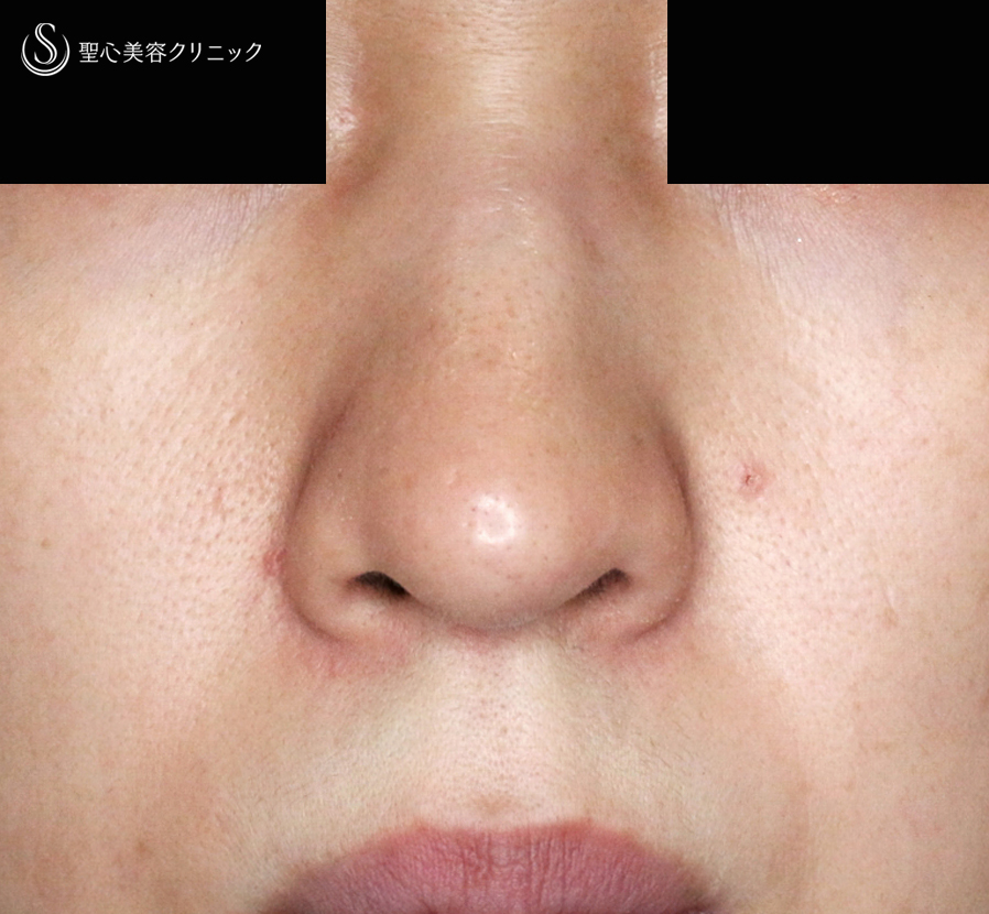 【30代女性・三角形の鼻の穴を整える】鼻孔縁下降術（術直後〜1年後） After 