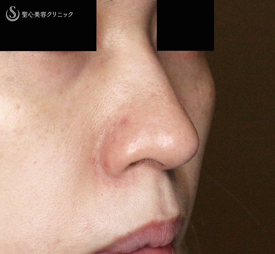 【30代女性・三角形の鼻の穴を整える】鼻孔縁下降術（術直後〜1年後） After 