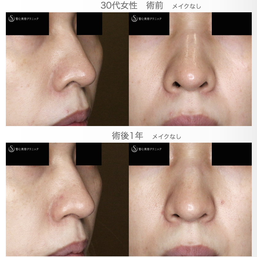 【30代女性・三角形の鼻の穴を整える】鼻孔縁下降術（術直後〜1年後） After 