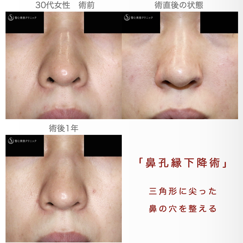 【30代女性・三角形の鼻の穴を整える】鼻孔縁下降術（術直後〜1年後） After 
