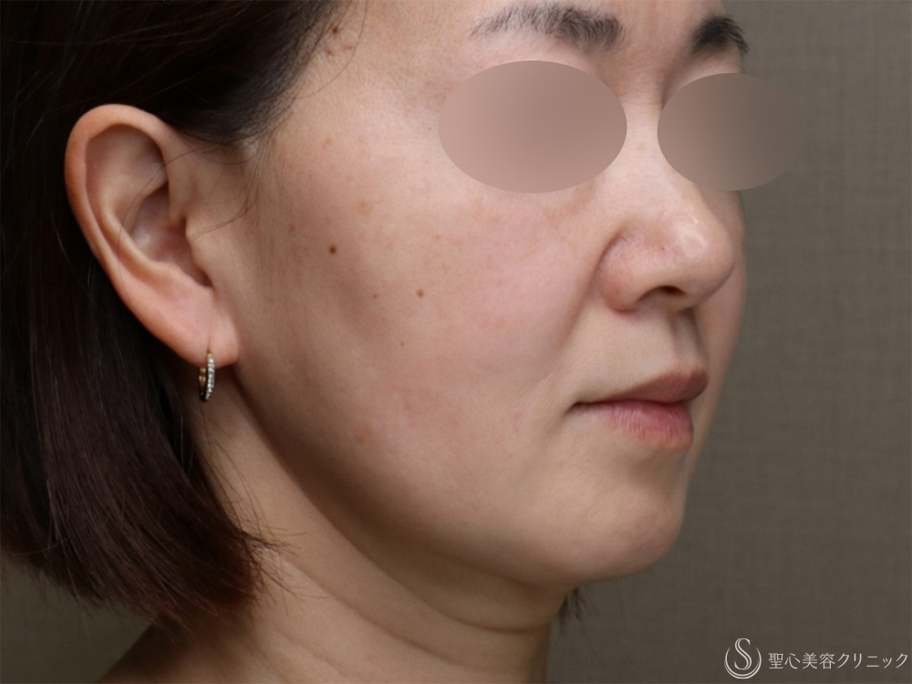 フィオラスレッドエスト FL＋アンカーMAX（サポートスレッド）_After