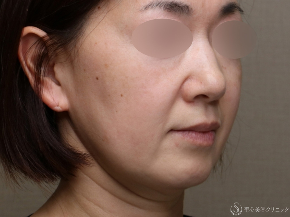 フィオラスレッドエスト FL＋アンカーMAX（サポートスレッド）_Before