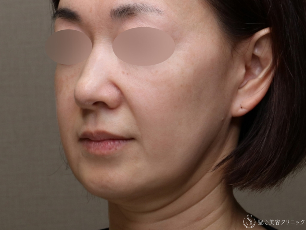 【40代女性・新しい糸リフトで口元のたるみがスッキリ】フィオラFL＋サポートスレッド（6本）(1ヶ月後) Before 