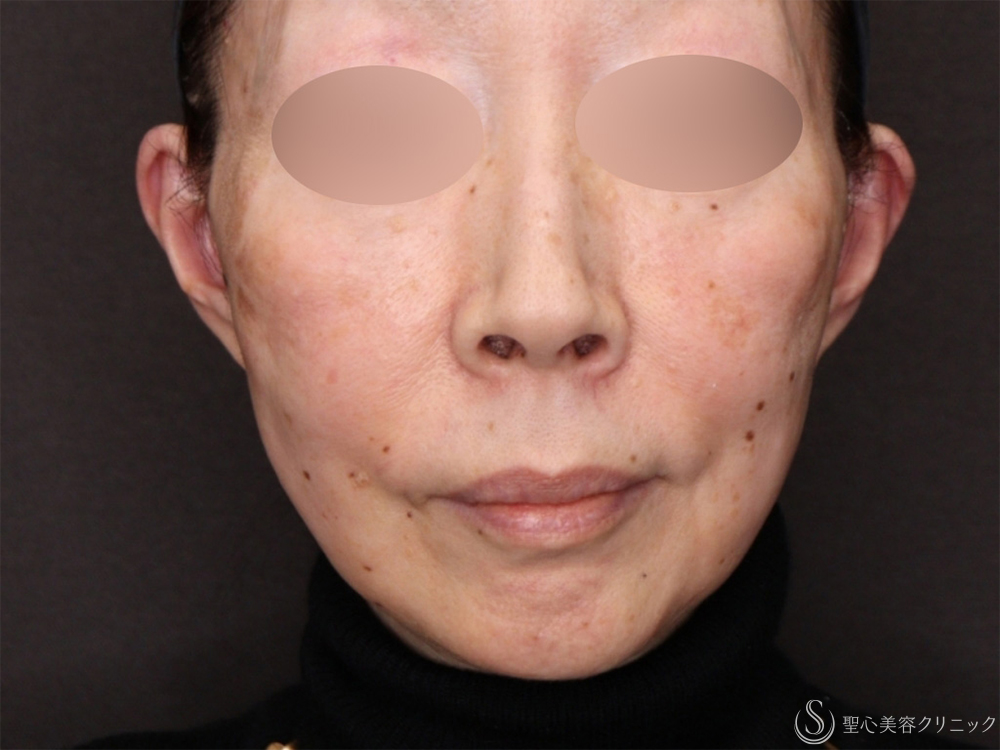 【60代女性・新しい糸リフトで口元のたるみがスッキリ】フィオラスレッドエストFL（4本）＋サポートスレッド（6本）（1ヶ月後） After 