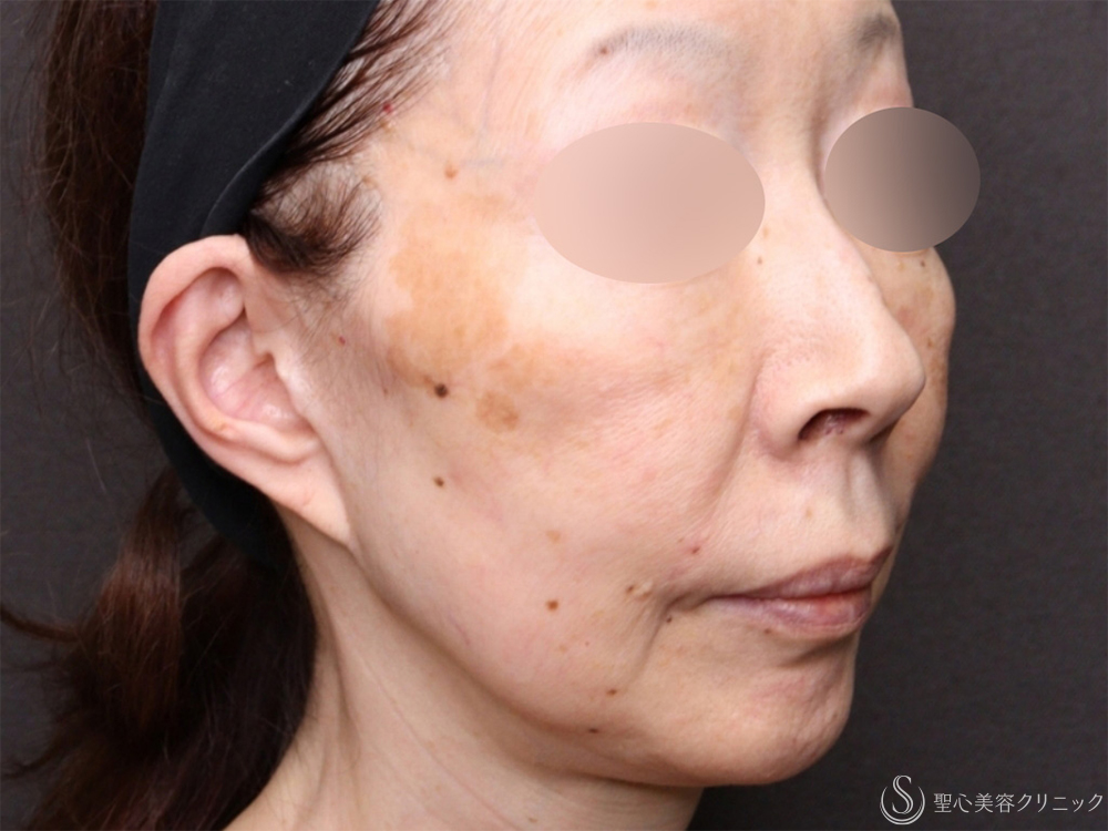 【60代女性・新しい糸リフトで口元のたるみがスッキリ】フィオラスレッドエストFL（4本）＋サポートスレッド（6本）（1ヶ月後） Before 