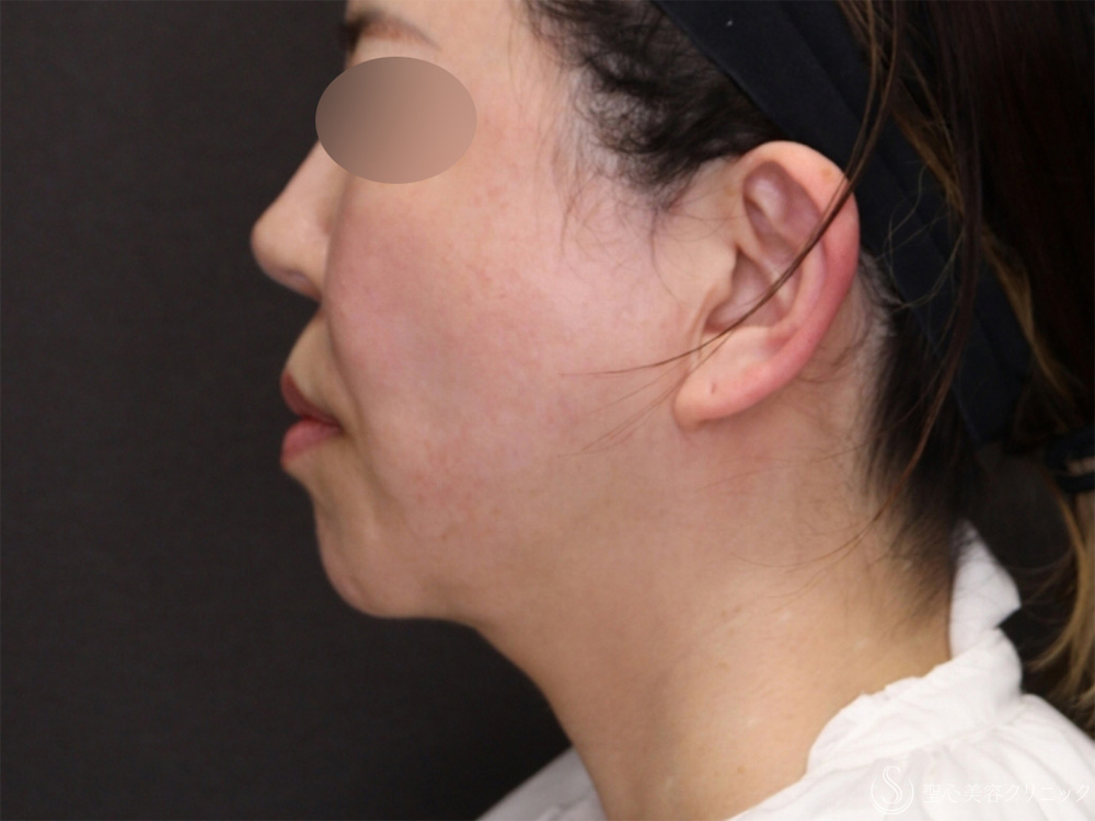 【50代女性・脂肪吸引と糸リフトでたるみのないスッキリとした顔に】ベイザーリポ2.2脂肪吸引＋アンカーDXダブル（バイニードル）（半年後） After 