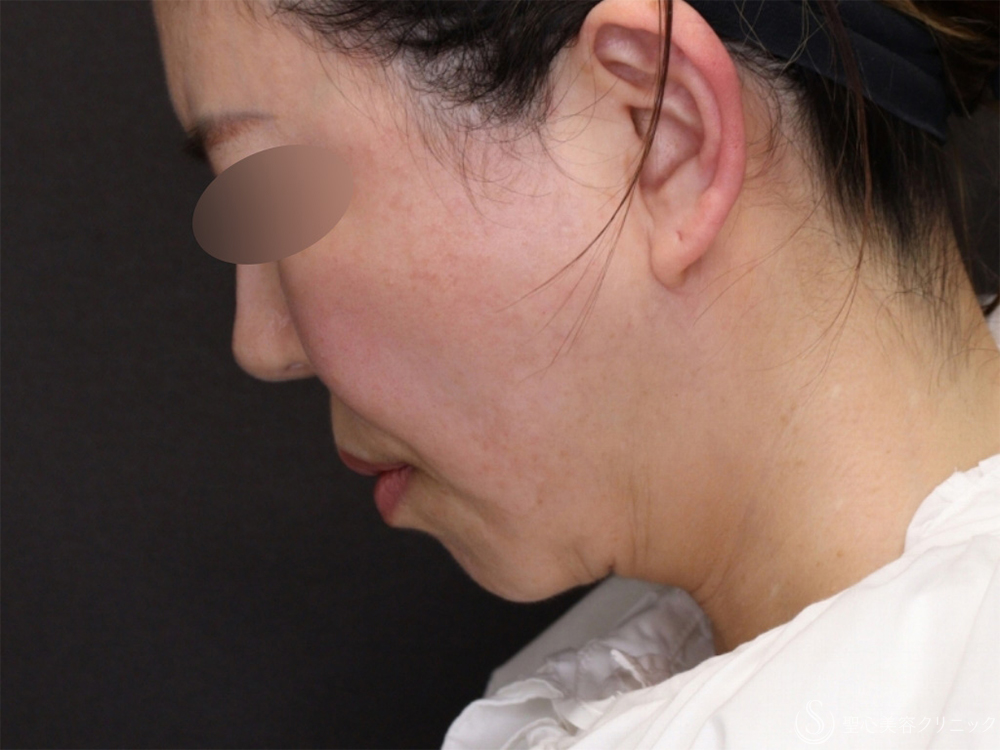 【50代女性・脂肪吸引と糸リフトでたるみのないスッキリとした顔に】ベイザーリポ2.2脂肪吸引＋アンカーDXダブル（バイニードル）（半年後） After 